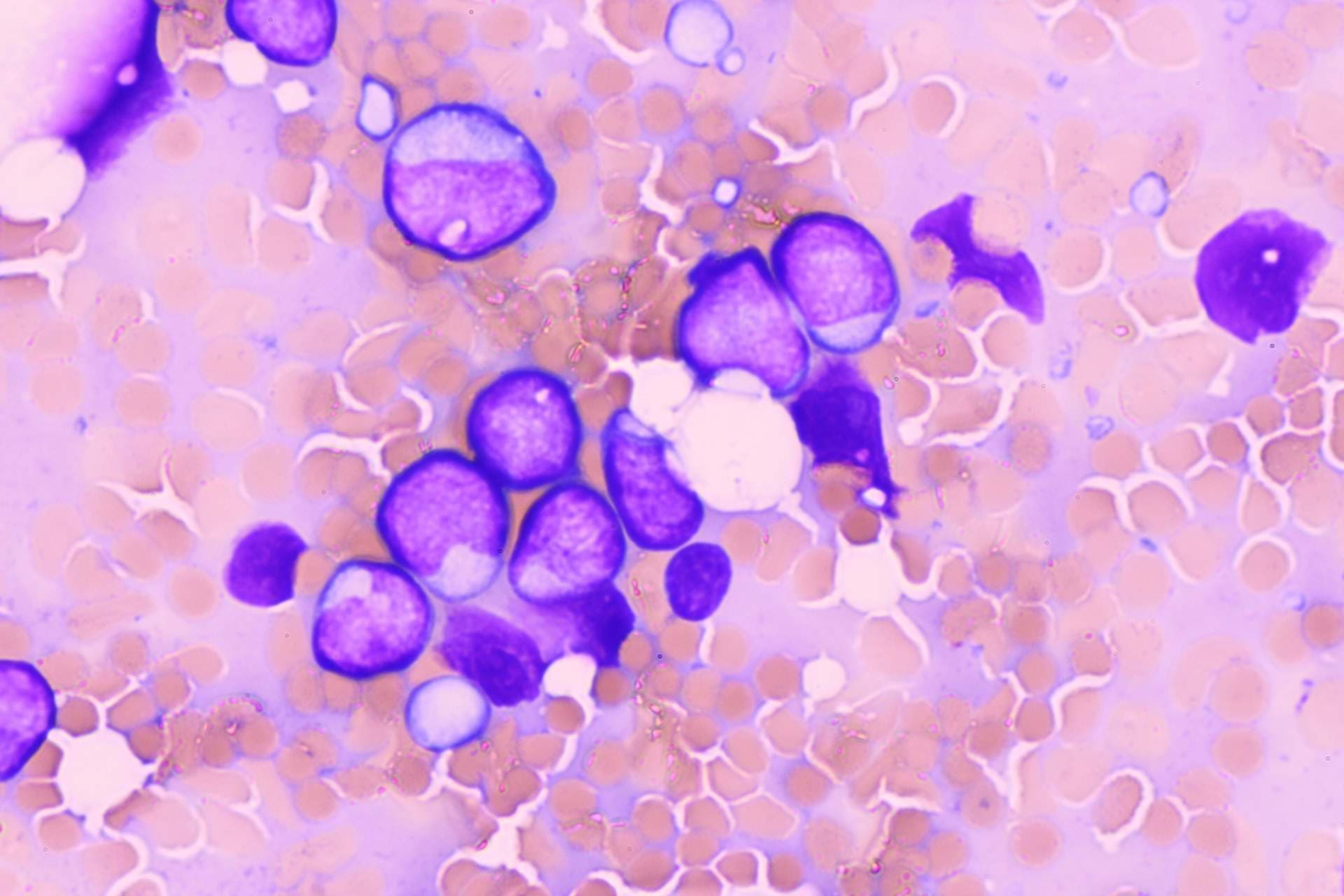 リンパ腫の細胞