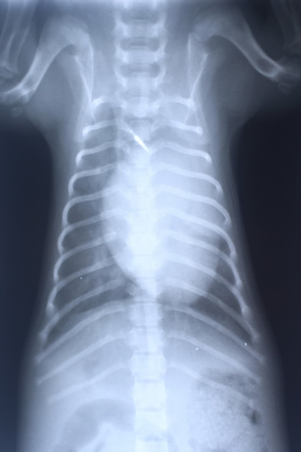 肛門嚢アポクリン腺癌