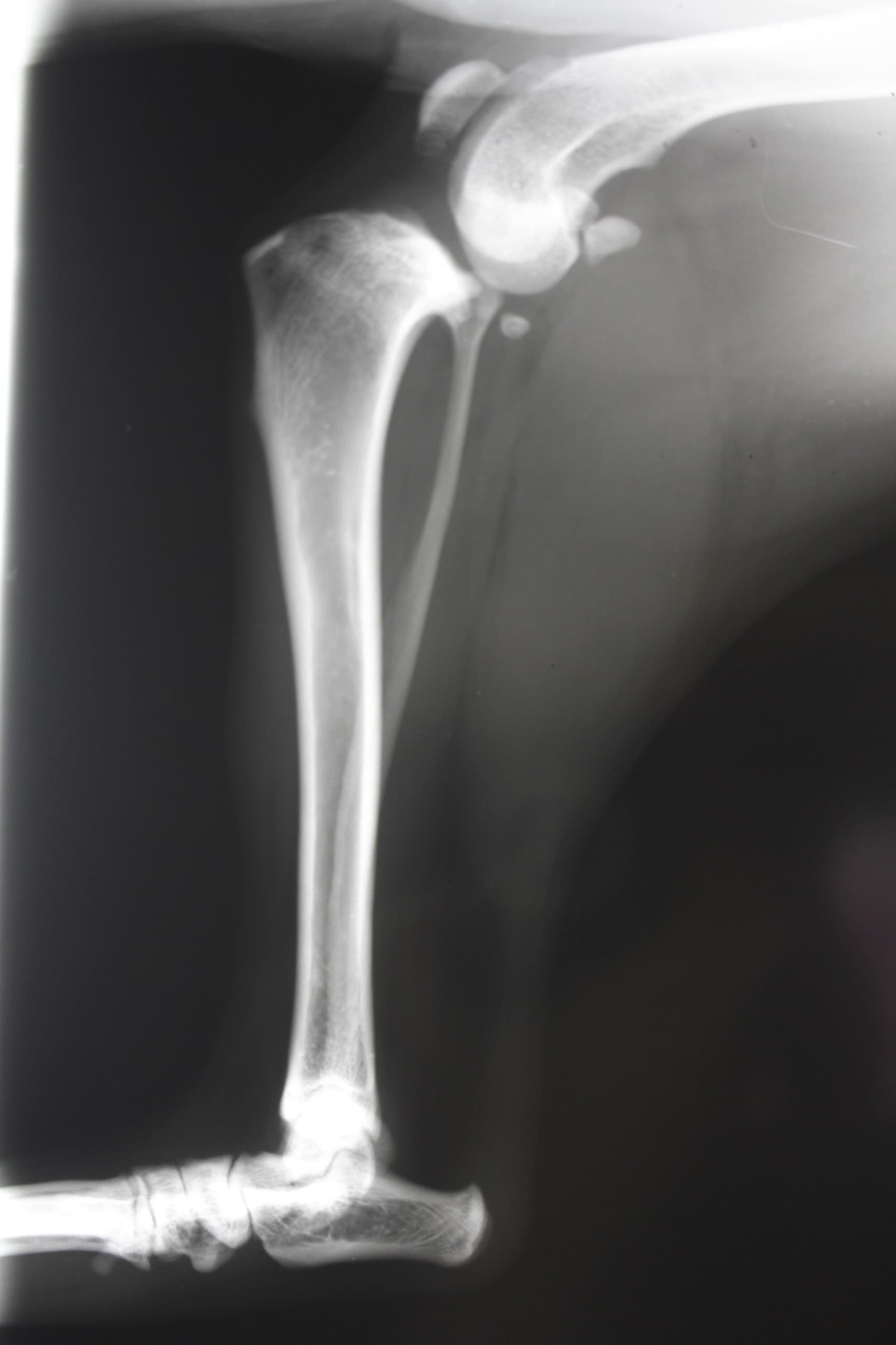 リンパ腫の細胞