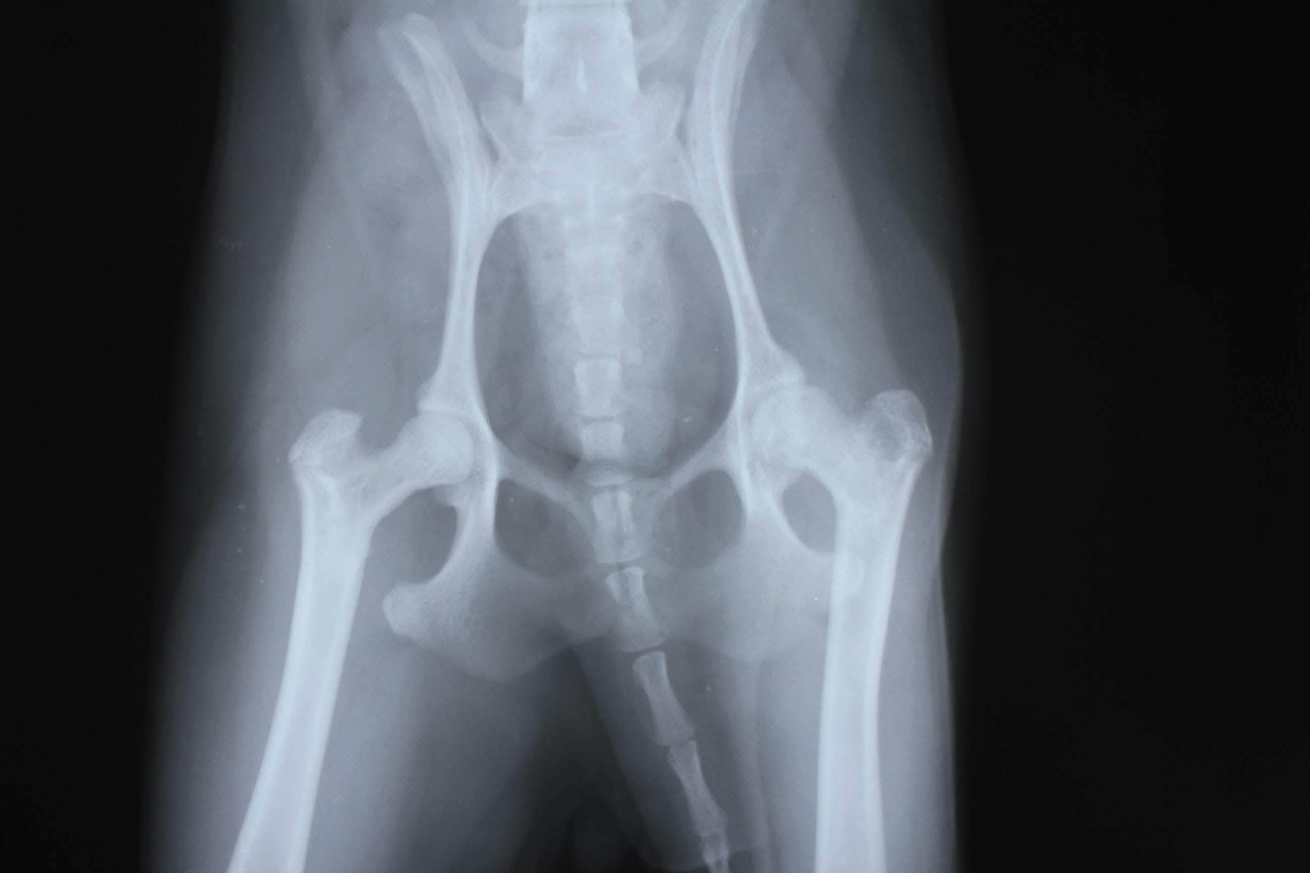 大腿骨頭壊死症の股関節のレントゲン写真
