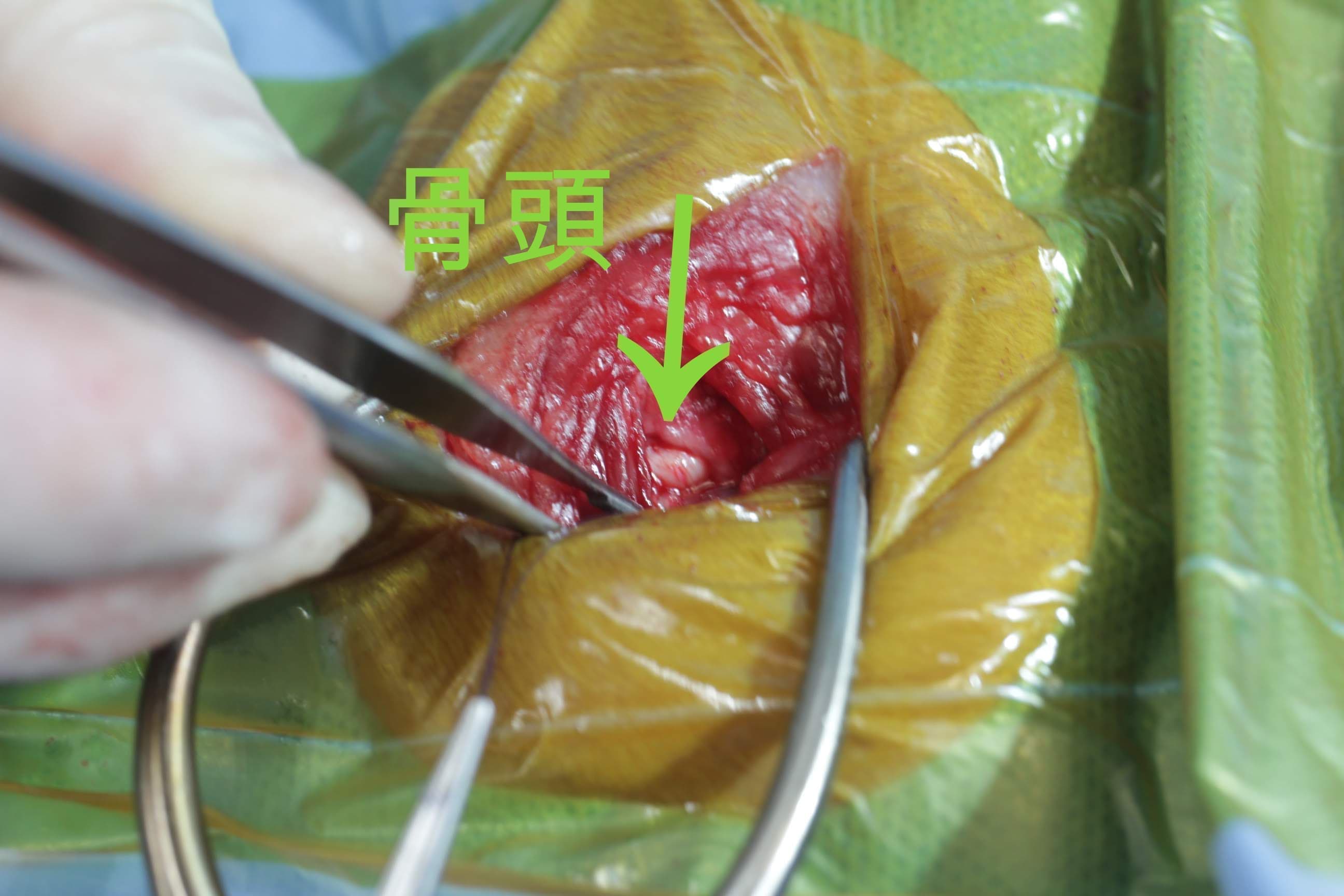 手術中の関節包切開と骨頭へのアプローチ