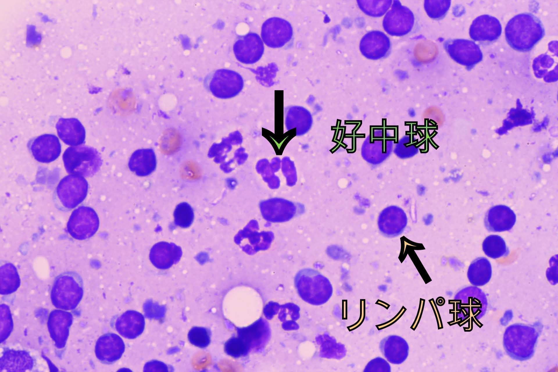 リンパの細胞検査　顕微鏡写真