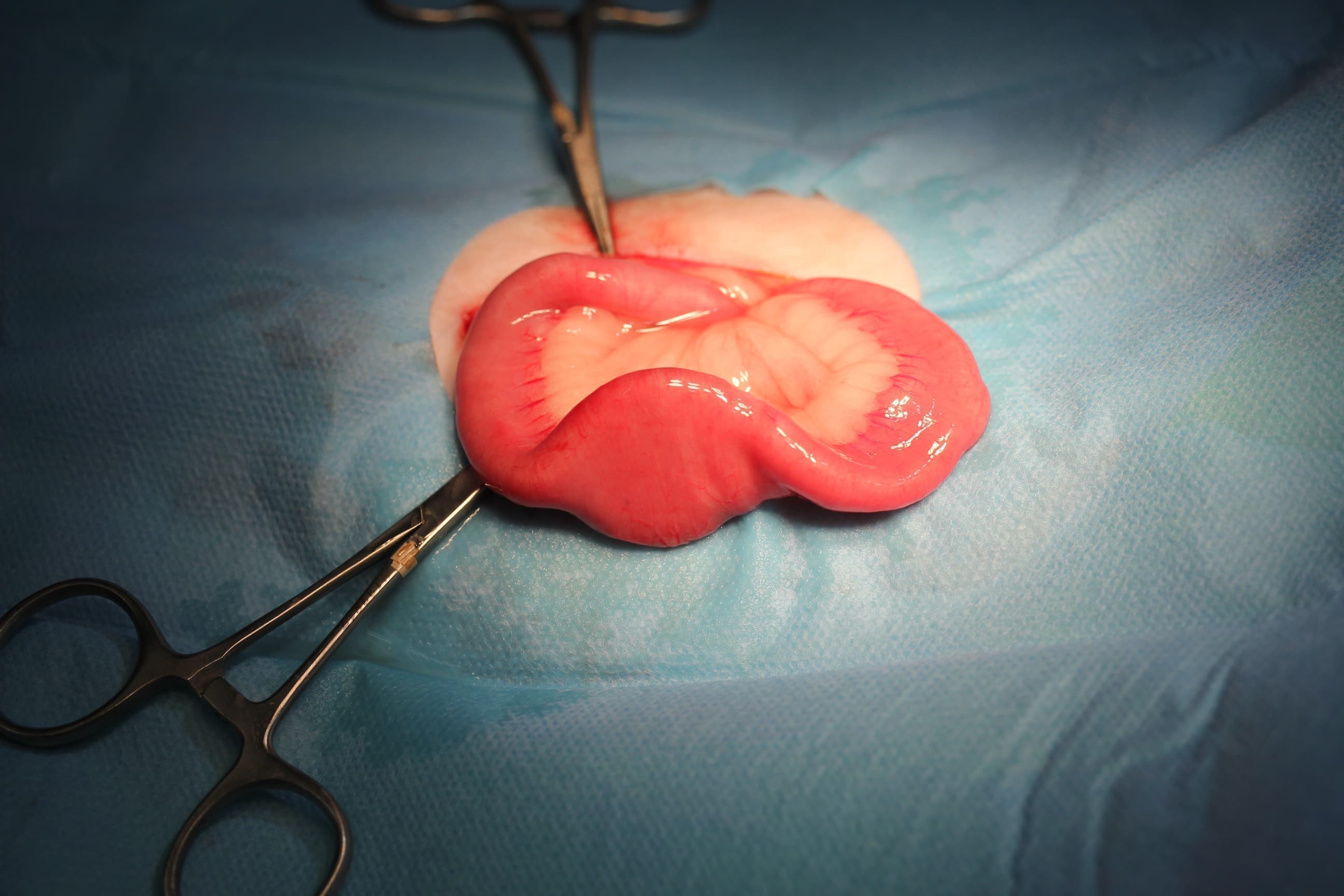 腸切開の手術